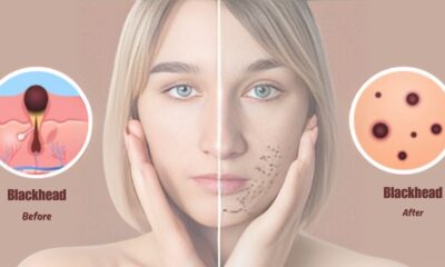 Blackhead removal