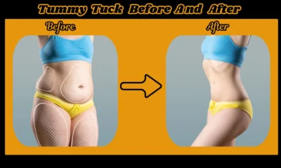 Tummy Tuck Before and After