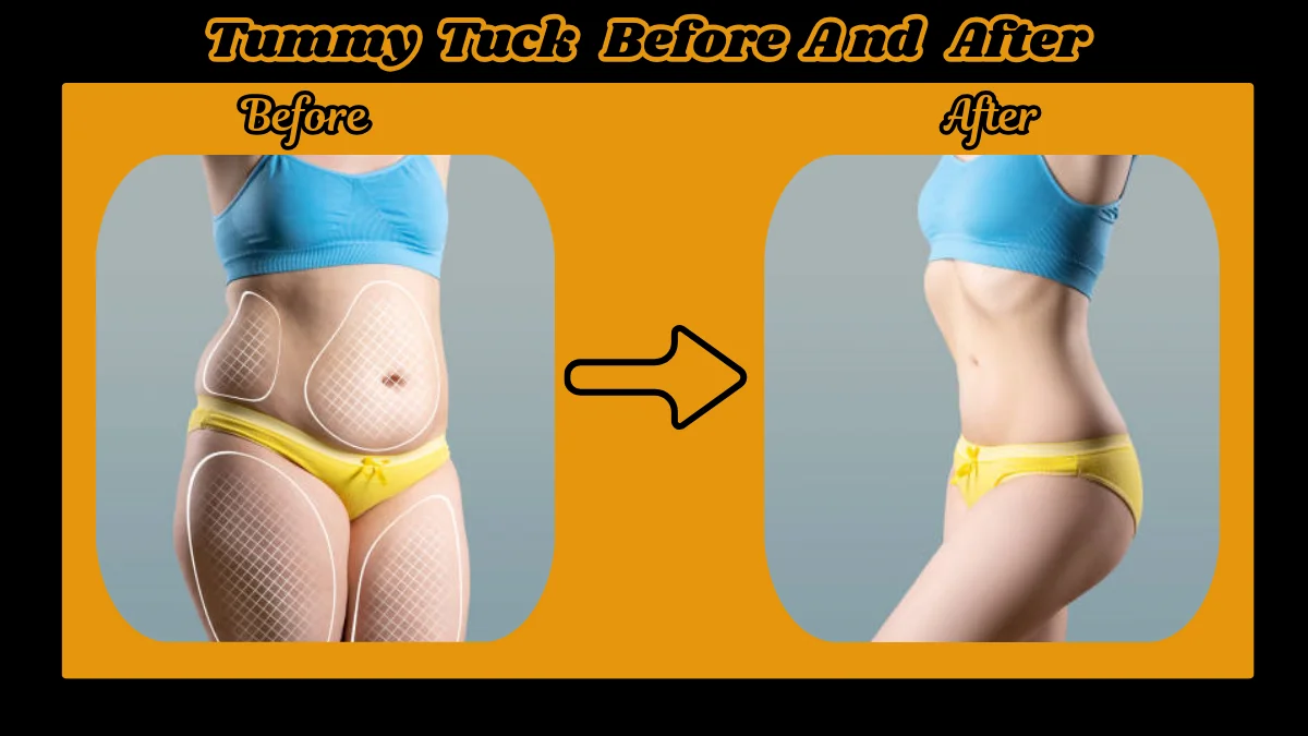 Tummy Tuck Before and After