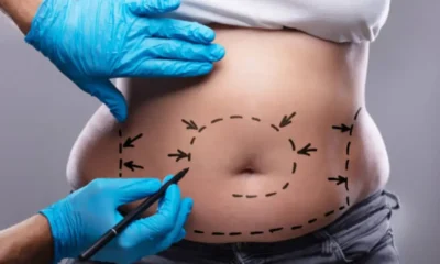 Liposuction