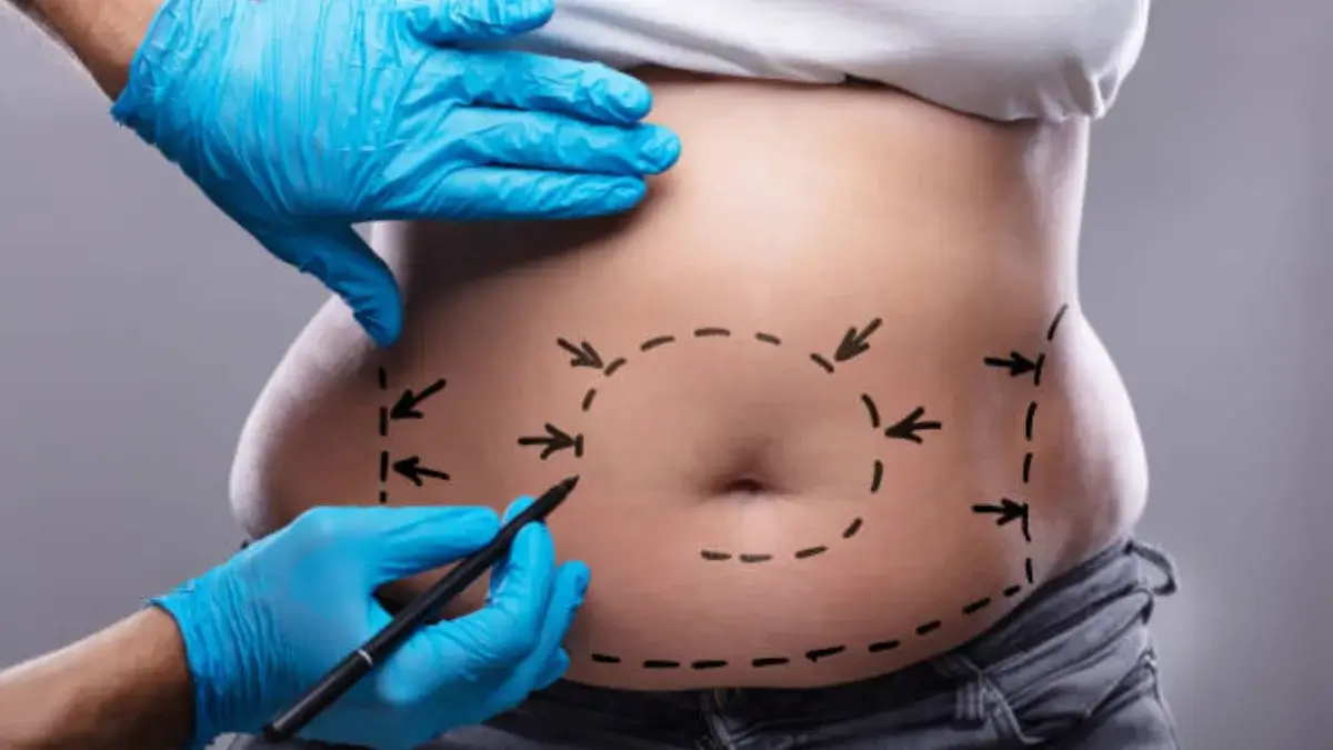 Liposuction