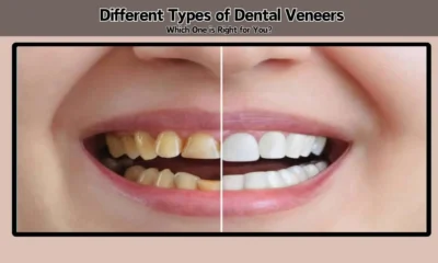 Dental Veneers
