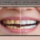Dental Veneers