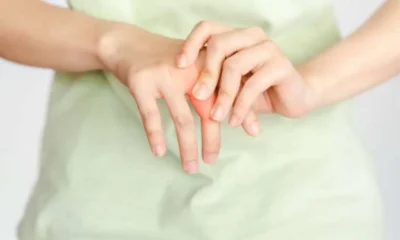 Rheumatoid Arthritis