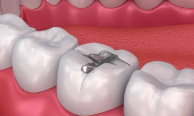 What Is a Tooth Filling? Types, Procedure, and Benefits