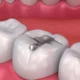 What Is a Tooth Filling? Types, Procedure, and Benefits