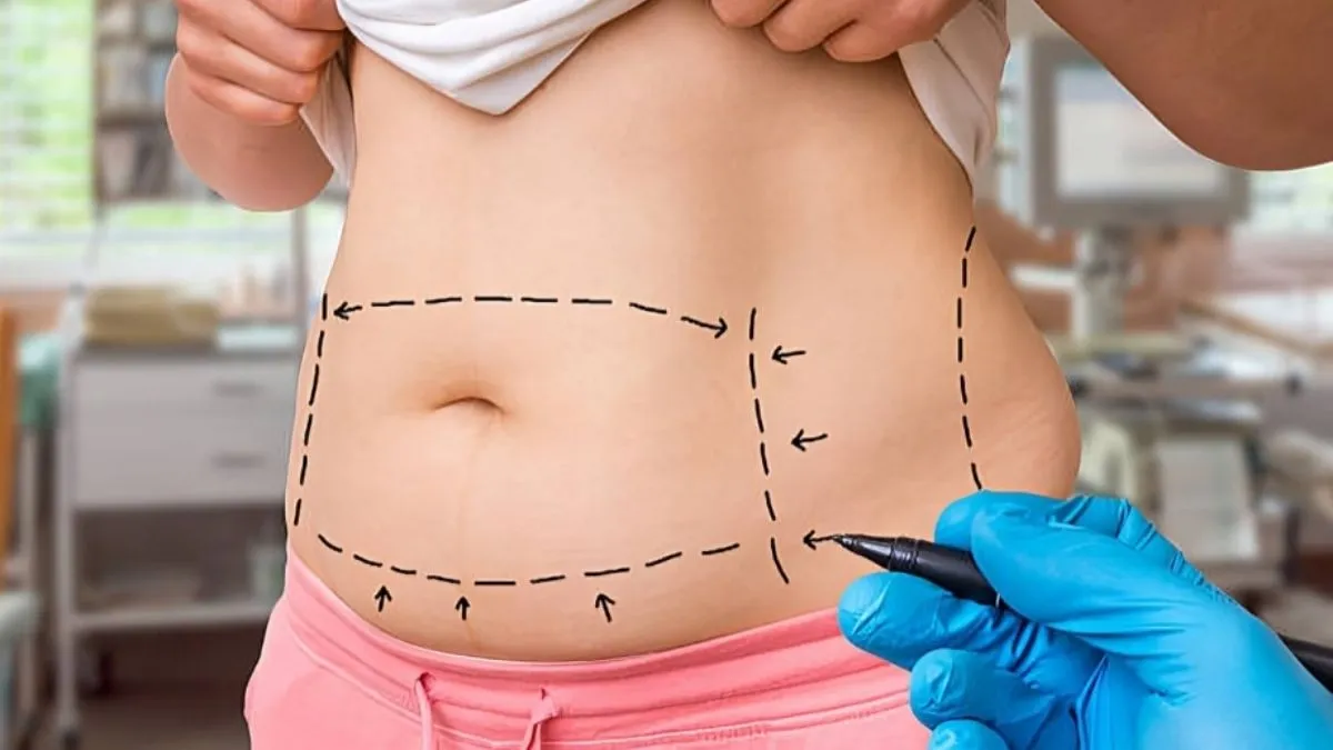 Advancements In Tummy Tuck Techniques: What St. George Patients Need To Know