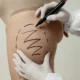 How Long Do Results Last? Nashville’s Top Cellulite Treatments Explained