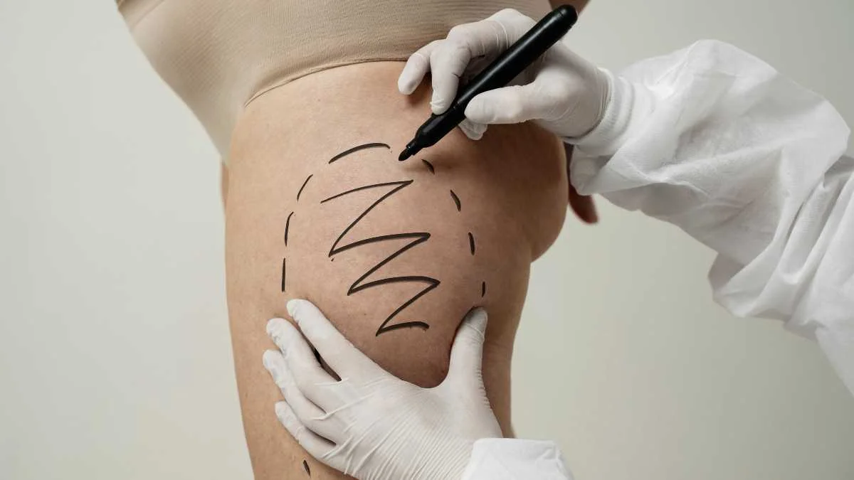 How Long Do Results Last? Nashville’s Top Cellulite Treatments Explained