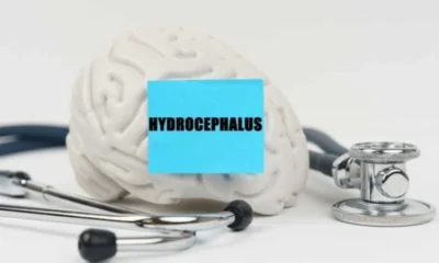 What is Hydrocephalus, and How is it Categorized?