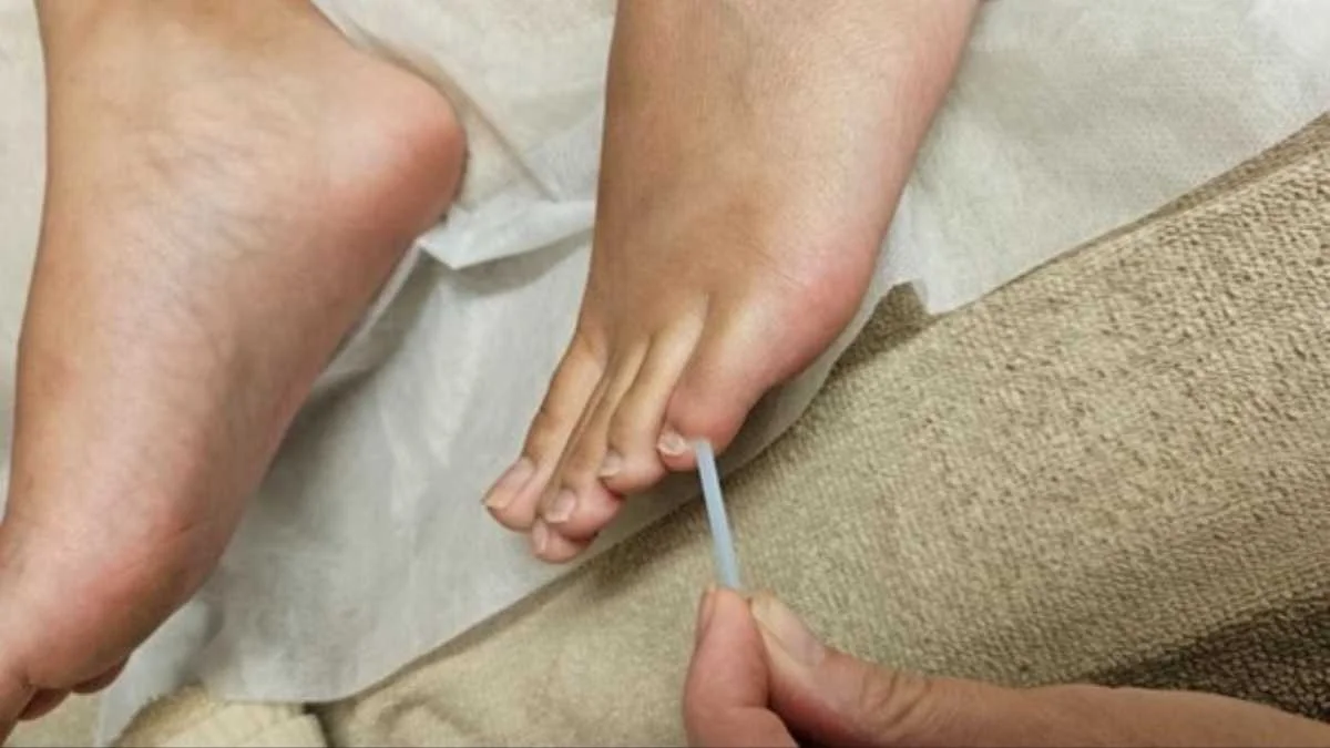 Acupuncture