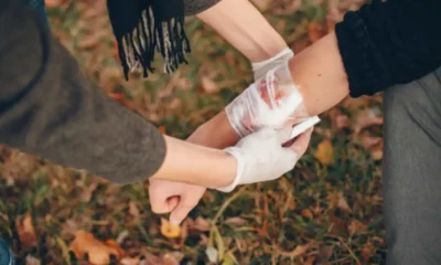 First Aid Tips to Keep in Mind That May Help After a Burn Injury