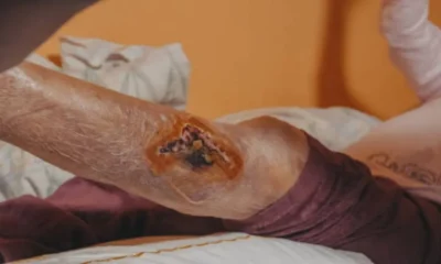 How Vascular Issues Affect Wound Healing: What Patients Need to Know