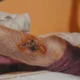 How Vascular Issues Affect Wound Healing: What Patients Need to Know