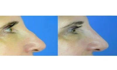 How to Smooth a Dorsal Hump Without Surgery