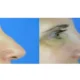 How to Smooth a Dorsal Hump Without Surgery