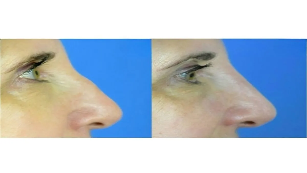 How to Smooth a Dorsal Hump Without Surgery