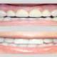 Why Cosmetic Dentistry at Ocean Hills Dentistry Delivers a Natural, Boutique-Quality Smile