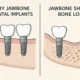 Bone Loss and Its Impact on Full Mouth Dental Implants