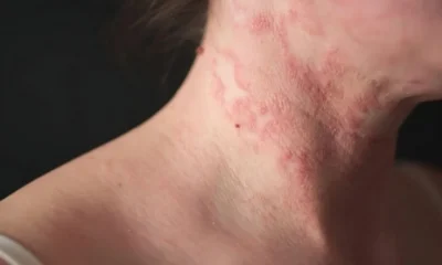 Effective Treatment for Eczema: How to Choose the Best Cream