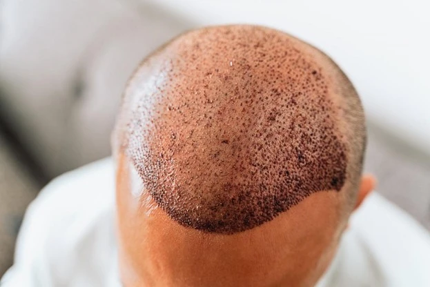How Much Does Hair Transplant Cost in UAE