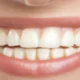 Professional and At-Home Teeth Whitening: Key Differences Explained