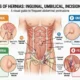 Common Types of Hernias
