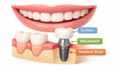 What to Expect Before, During, and After Dental Implant Surgery