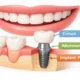 What to Expect Before, During, and After Dental Implant Surgery