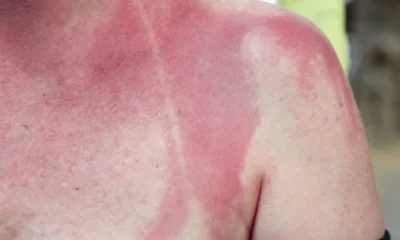 Can Accutane Sun Exposure Make Your Skin Burn Faster?