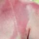 Can Accutane Sun Exposure Make Your Skin Burn Faster?
