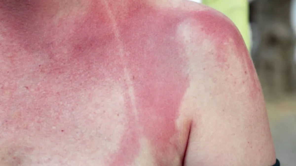 Can Accutane Sun Exposure Make Your Skin Burn Faster?