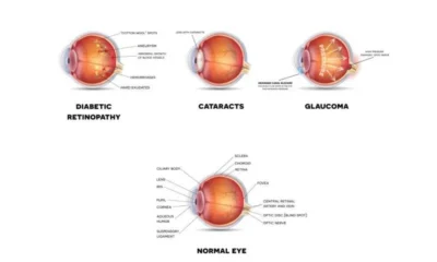 Cataracts and Diabetes: What Patients in Singapore Should Know
