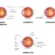 Cataracts and Diabetes: What Patients in Singapore Should Know