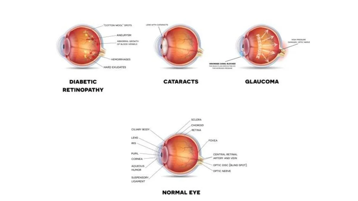 Cataracts and Diabetes: What Patients in Singapore Should Know