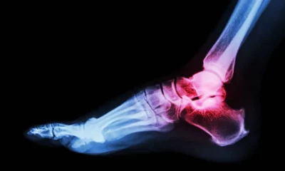 Preparing for Foot and Ankle Surgery: What Patients in Singapore May Need to Know