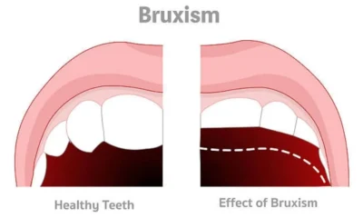 Teeth Grinding Causes, Symptoms, and Treatment Options