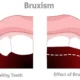 Teeth Grinding Causes, Symptoms, and Treatment Options