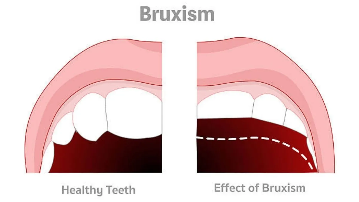 Teeth Grinding Causes, Symptoms, and Treatment Options