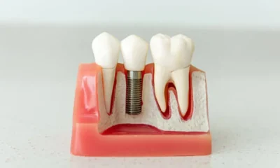 What to Know Before Getting Dental Implants in The Woodlands, TX