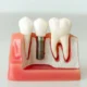 What to Know Before Getting Dental Implants in The Woodlands, TX