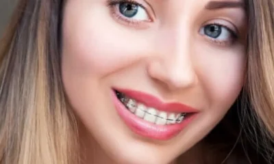 Damon Self-Ligating Braces: How They Differ From Traditional Braces