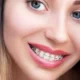 Damon Self-Ligating Braces: How They Differ From Traditional Braces