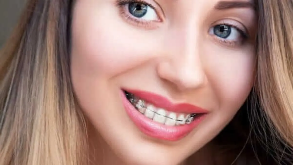 Damon Self-Ligating Braces: How They Differ From Traditional Braces