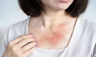 How Dermatologists Treat Chronic Skin Conditions