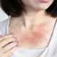 How Dermatologists Treat Chronic Skin Conditions