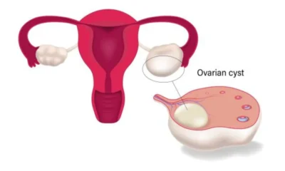 When an Ovarian Cyst Diagnosis May Need a Second Opinion