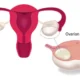 When an Ovarian Cyst Diagnosis May Need a Second Opinion