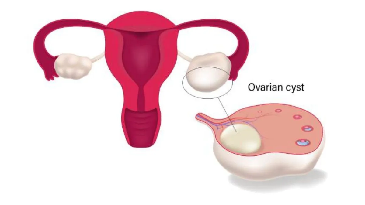 When an Ovarian Cyst Diagnosis May Need a Second Opinion