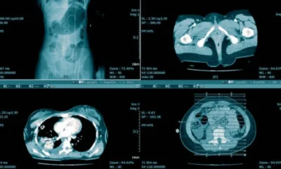 Kidney Stones and Urinary Problems: Understanding CT Urinary Tract Imaging
